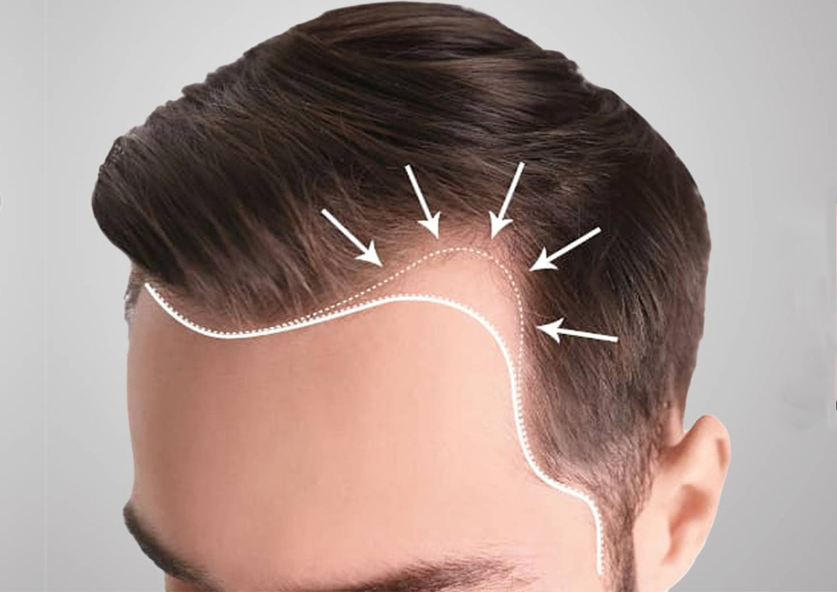 FUE Hair Transplant Explained